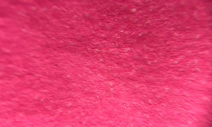 Should skin cysts be removed?